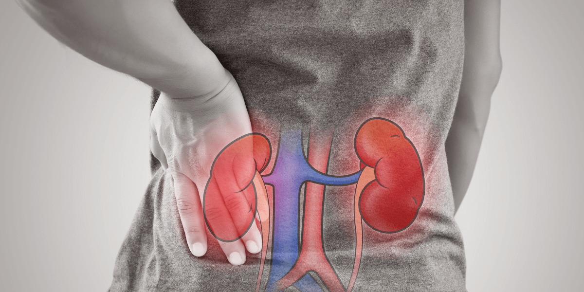 What Is a Kidney Transplant?